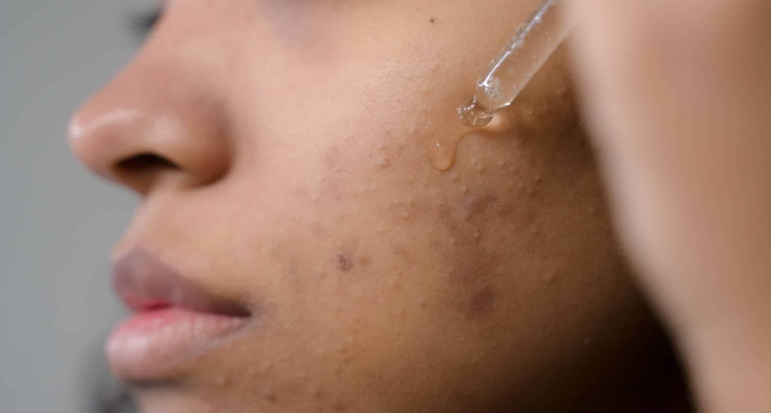 How CBD Can Help Against Acne